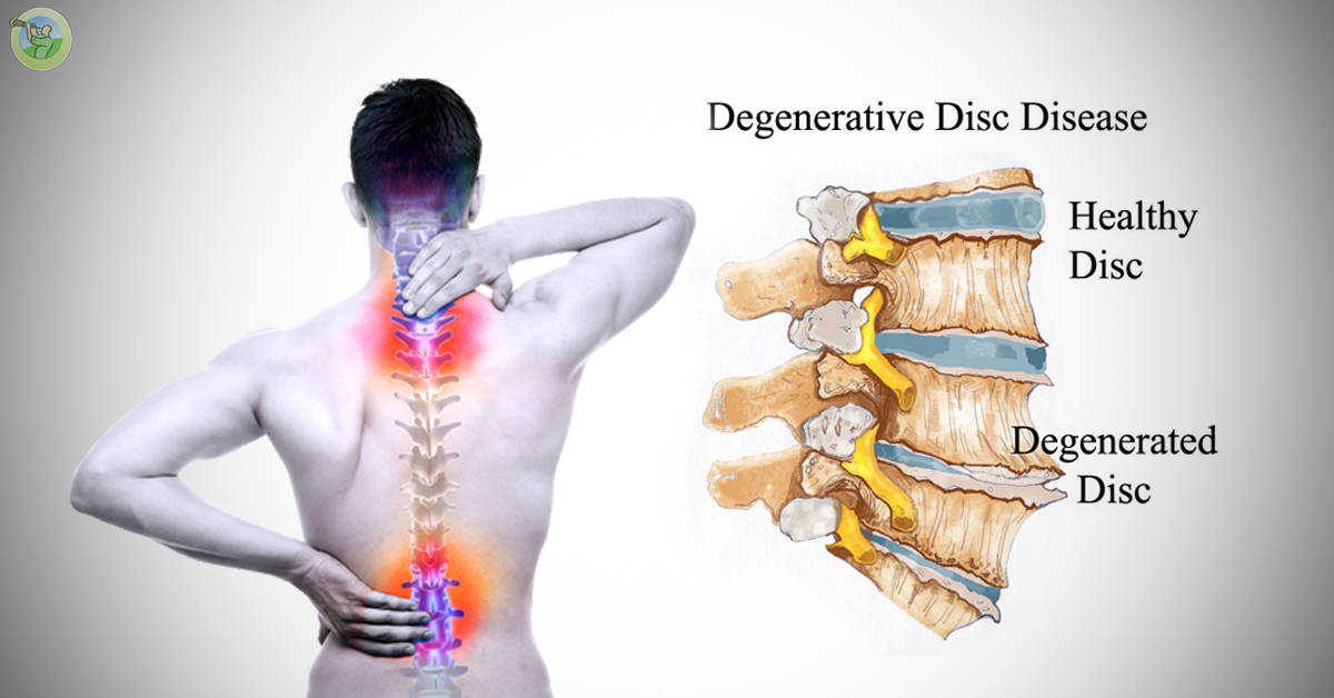 Degenerative-Disk-Disease.png