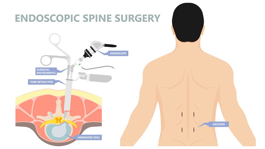Endoscopic-Spine-Surgery.jpg
