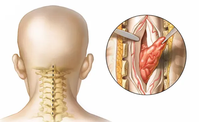 spinal-tumor-neck-surgery-8col-e1713348469200.webp
