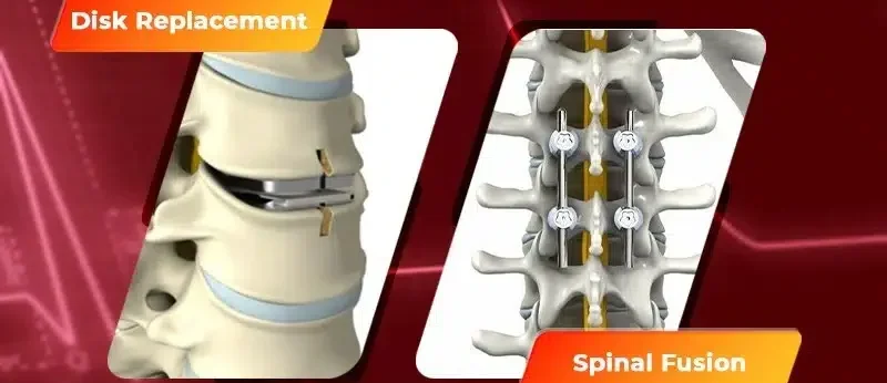 artifical-disc-replacement-or-spinal-fusion-e1714551128810.webp