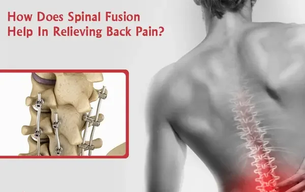 How-Does-Spinal-Fusion-Help-In-Relieving-Back-Pain.jpg-e1722421316376.webp